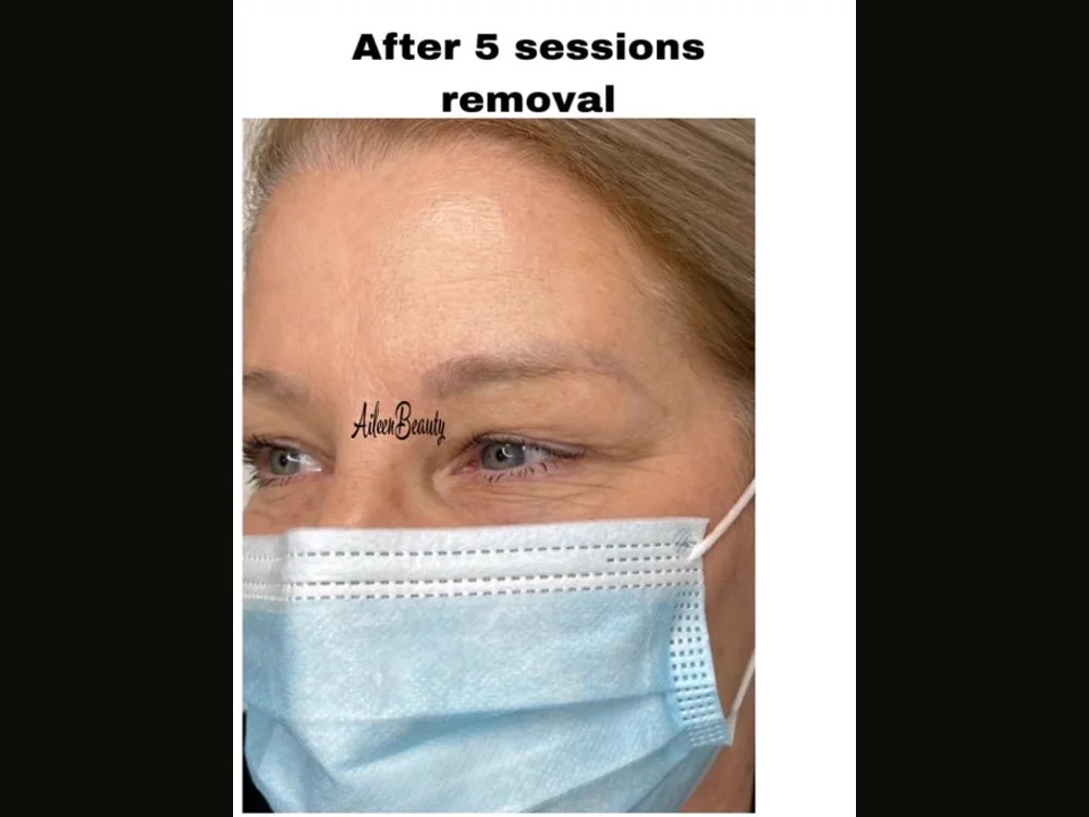 Faded cool-toned brow tattoo — after non-laser removal, real client