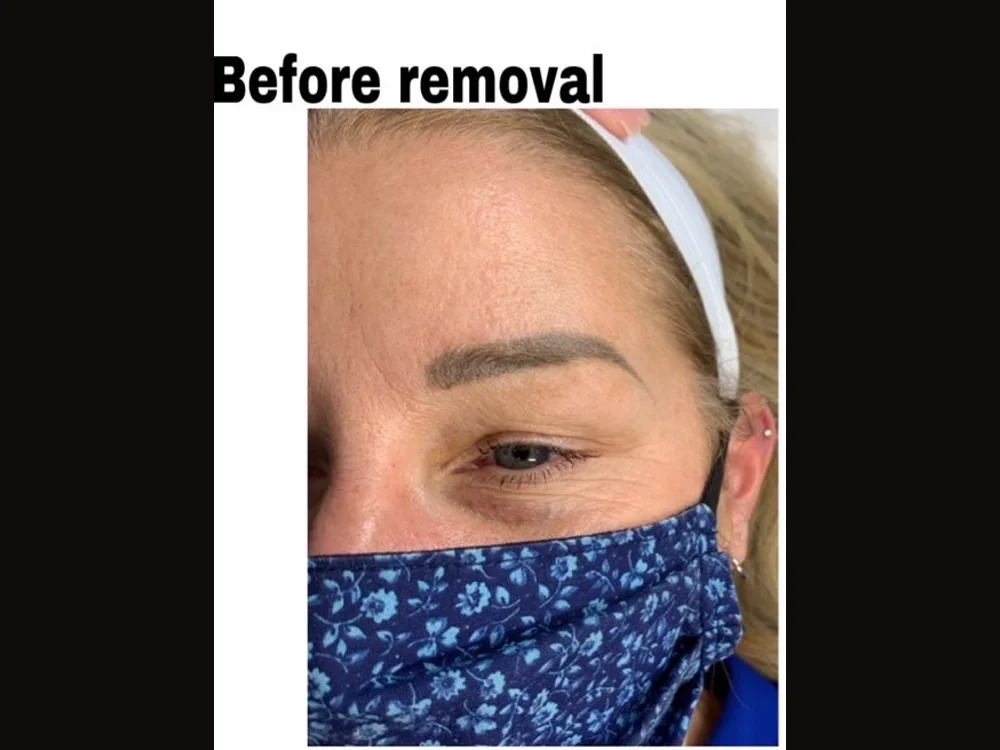 Faded cool-toned brow tattoo — before removal, real client