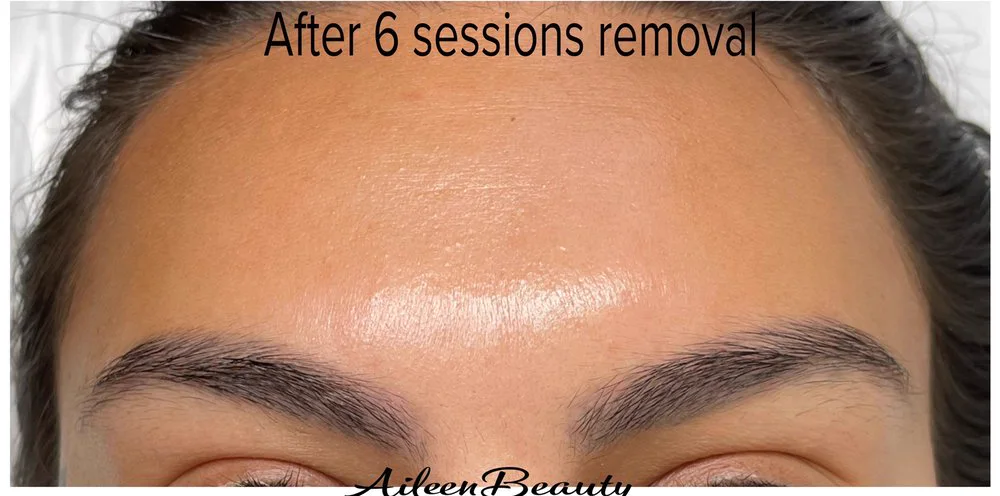 Dark saturated brow tattoo — after non-laser removal, real client