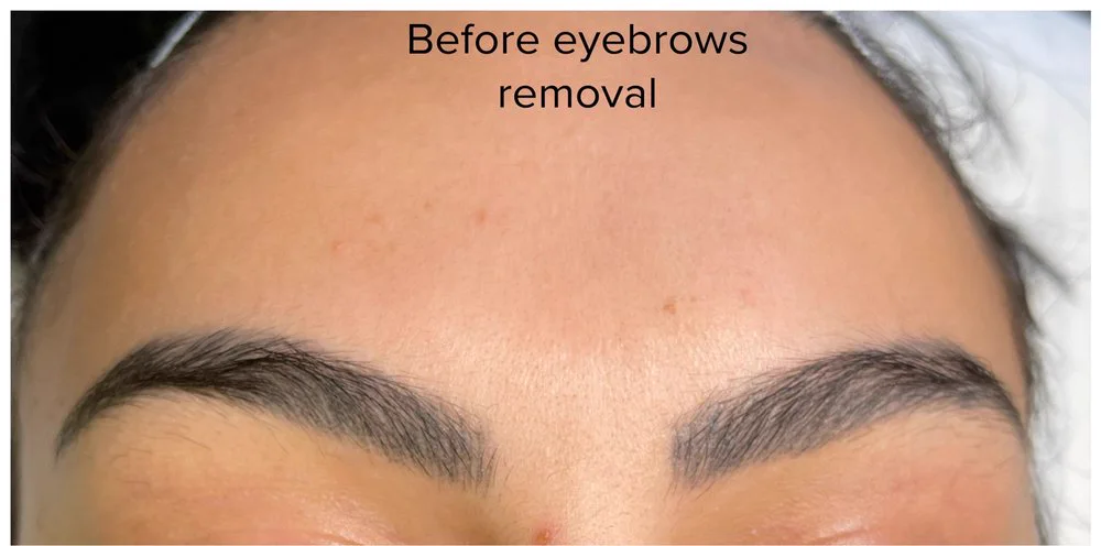 Dark saturated brow tattoo — before removal, real client