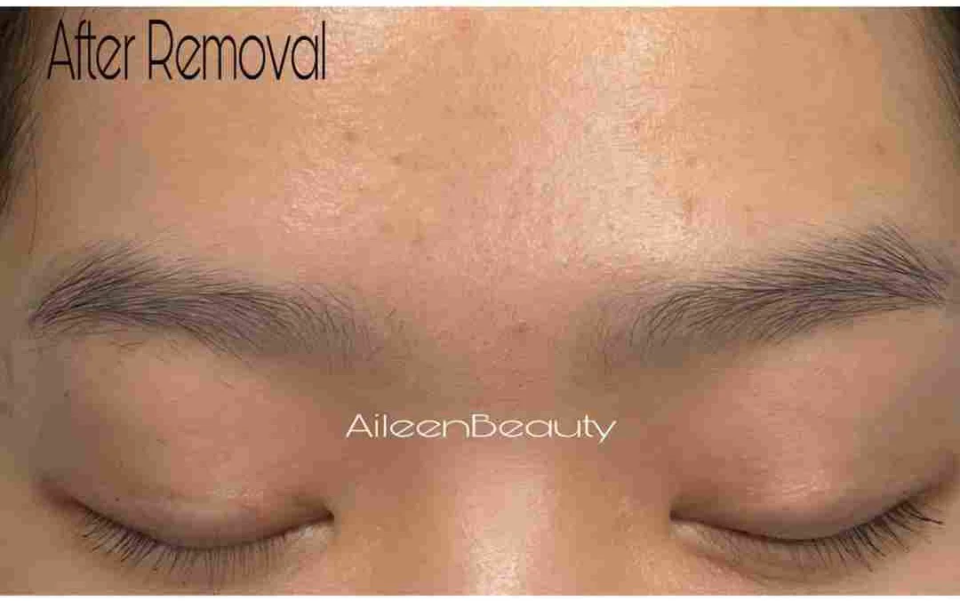 Old microblading — after non-laser removal, real client