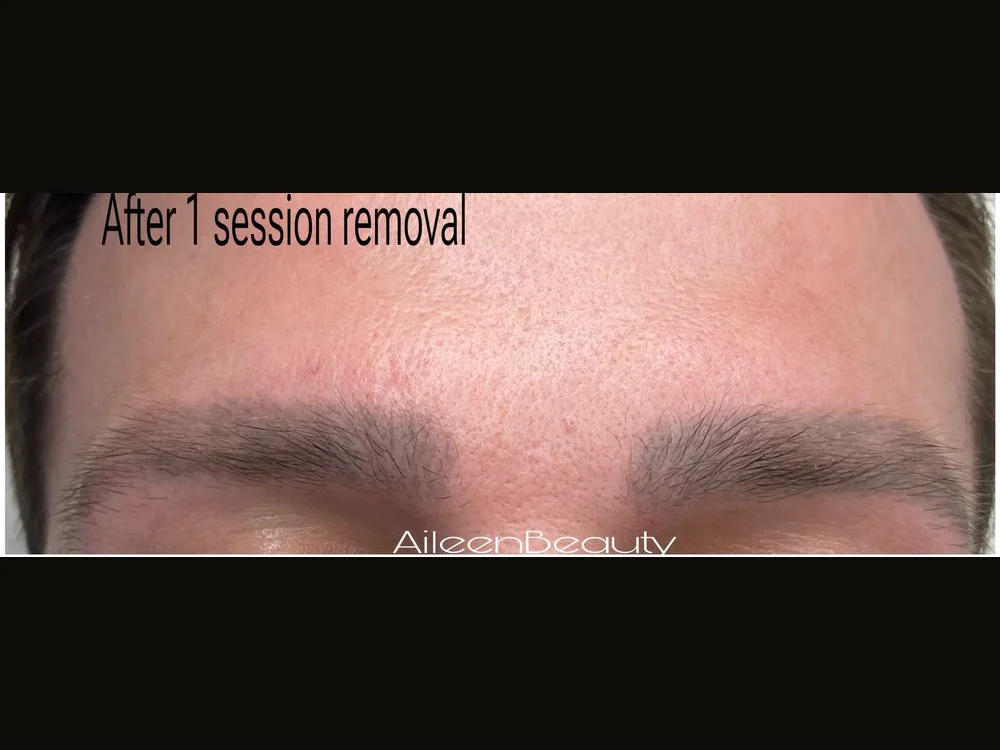 Dark brow tattoo (male client) — after non-laser removal, real client