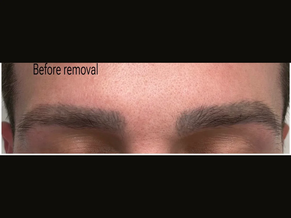 Dark brow tattoo (male client) — before removal, real client