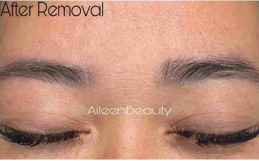Faded cosmetic tattoo — after non-laser removal, real client