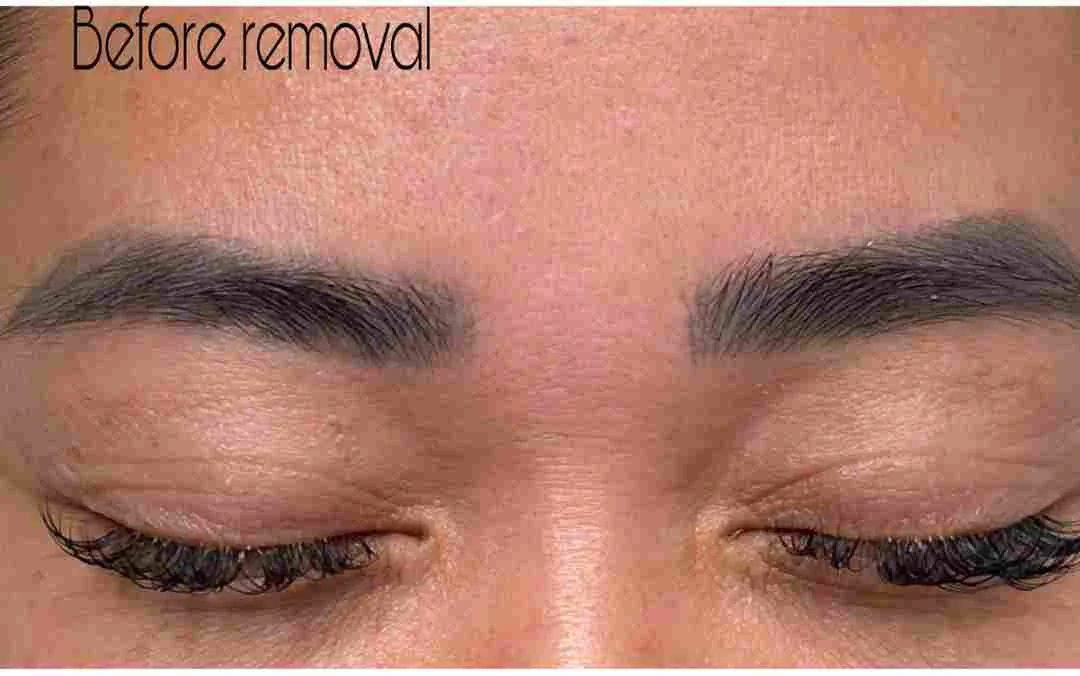 Faded cosmetic tattoo — before removal, real client
